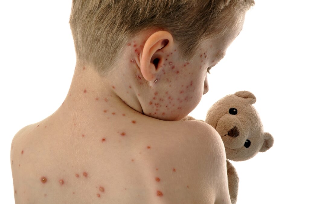 Why Has The Number Of Measles Cases Been Rising So Rapidly All Over The World?